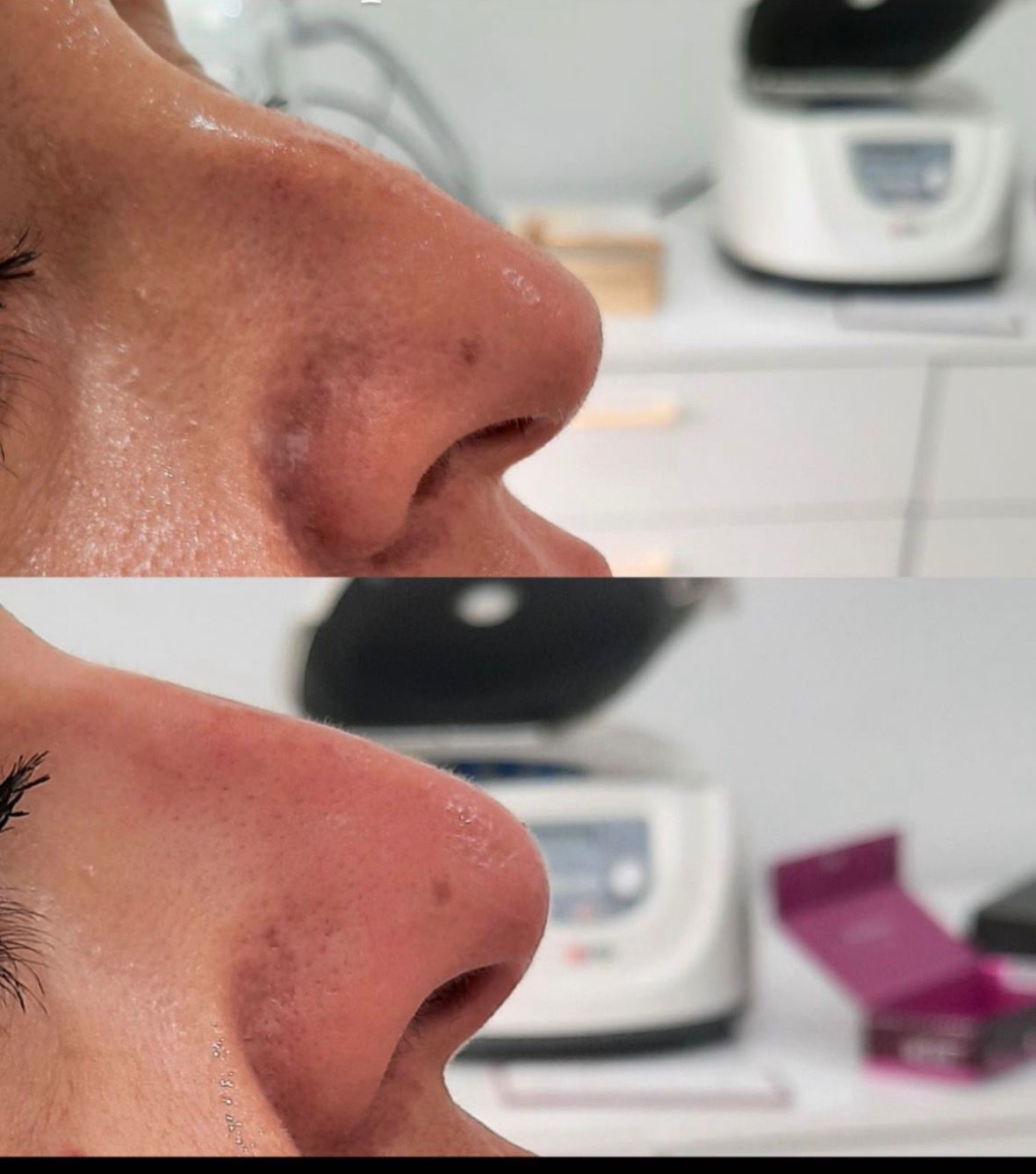 Rhinoplastie Médicale